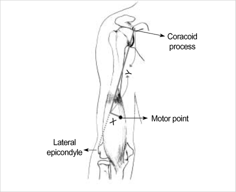 Anatomic Motor Point Localization Of The Biceps Brachii And Brachialis