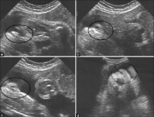 The Accuracy Of 2D Ultrasound Prenatal Sex Determination ScienceOpen