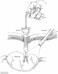 A Simple And Safe Minimally Invasive Technique For Laparoscopic Gastrostomy Scienceopen