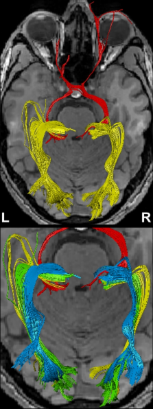 Optic Tract Pathway Mri