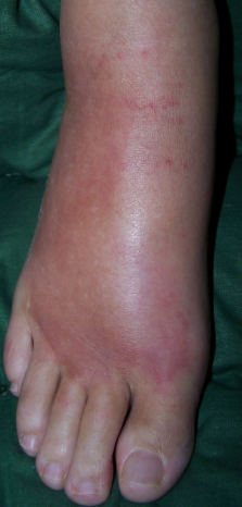 Sudeck's disease stage 1, or diabetic Charcot's foot stage 0? Case