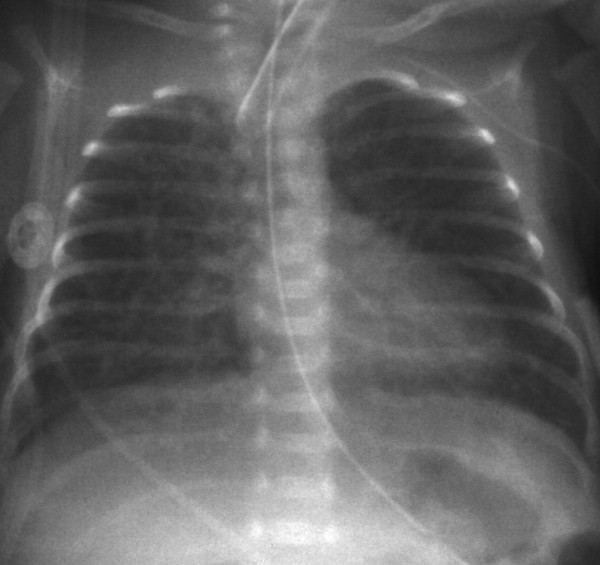 Percutaneous evacuation of diffuse pulmonary interstitial emphysema by ...