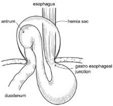 Paraesophageal hernia with incarceration of the gastric antrum and ...