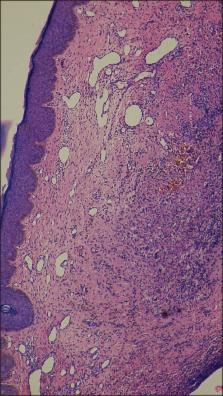 Retroauricular Nodules in a Post-Renal Transplant Individual – ScienceOpen