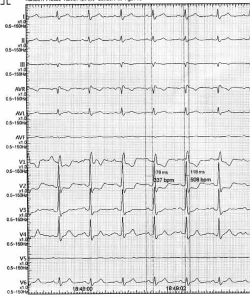 A Case of Premature Ventricular Complexes from the Proximal Left Bundle ...