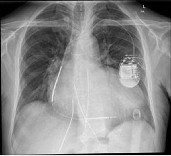 A mandatory modification in extracorporeal biventricular assist device ...