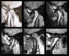 Resumo de disfunção temporomandibular: diagnóstico, tratamento e mais!