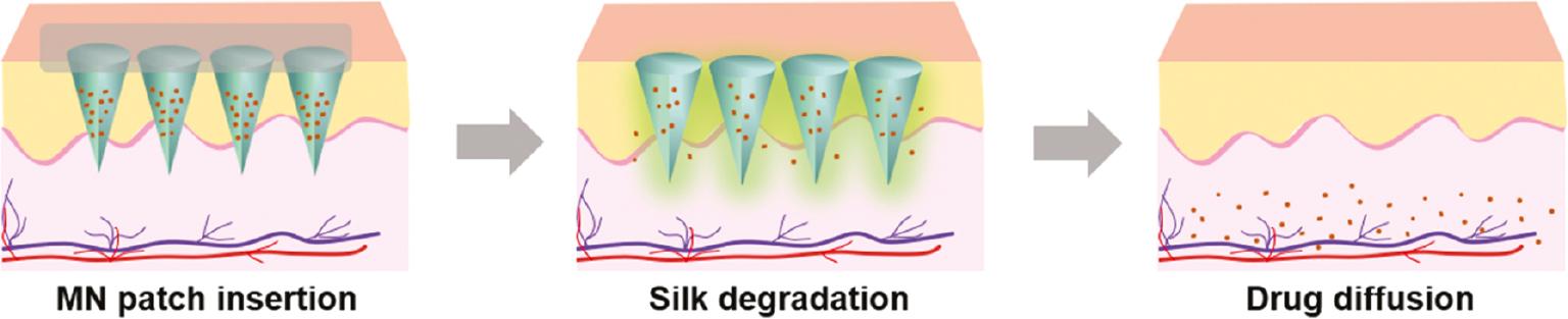 Advances in microneedle patches for long-acting contraception – ScienceOpen