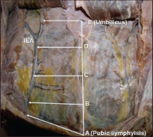 inferior epigastric artery laparoscopy