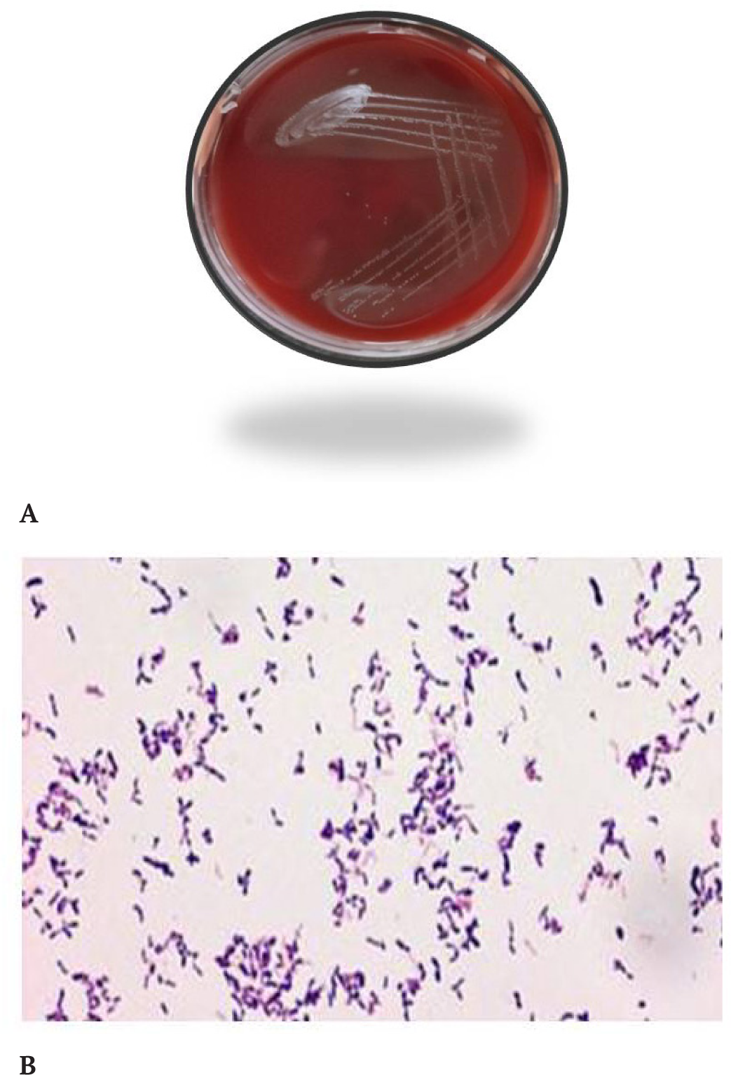 Three cases of Actinomyces isolation from the eye lesions of