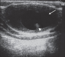 Anterior abdominal wall cysticercosis-the role of high-resolution USG ...