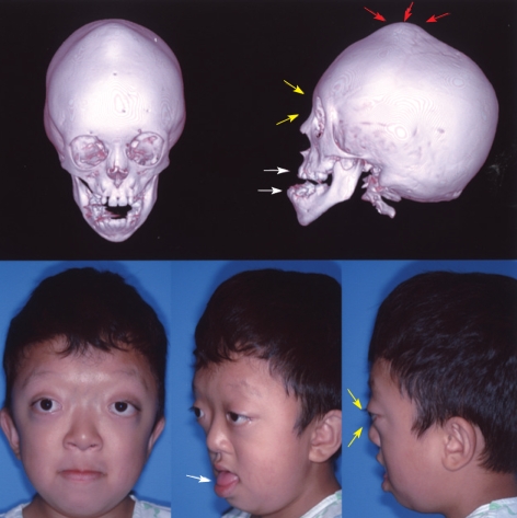 Monoblock Craniofacial Internal Distraction in a Child with Pfeiffer