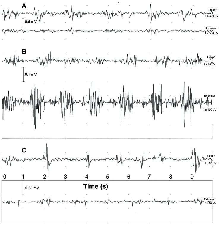 Clinical Differentiation of Essential Tremor and Parkinson’s Disease ...