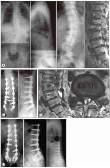 Surgical Treatment Of Adult Degenerative Scoliosis – ScienceOpen