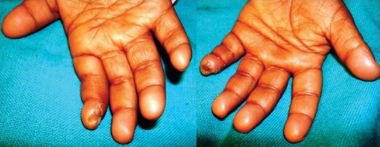 Congenital Insensitivity to Pain and Anhidrosis: A Case Report from ...