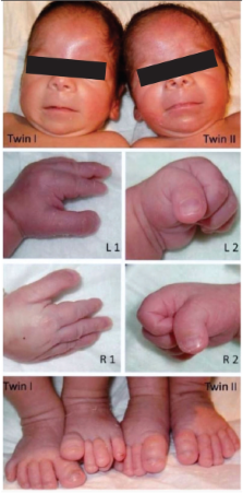 4 Newborn with Rubinstein-Taybi syndrome showing microcephaly