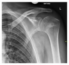 Arthroscopic-Assisted Treatment of a Reversed Hill-Sachs Lesion ...