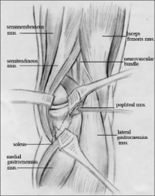 Surgical approach for high-energy posterior tibial plateau fractures ...