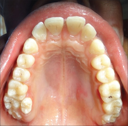 Paramolar A Supernumerary Molar A Case Report And An Overview Scienceopen 0721