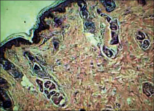 porencephalic cyst pathology