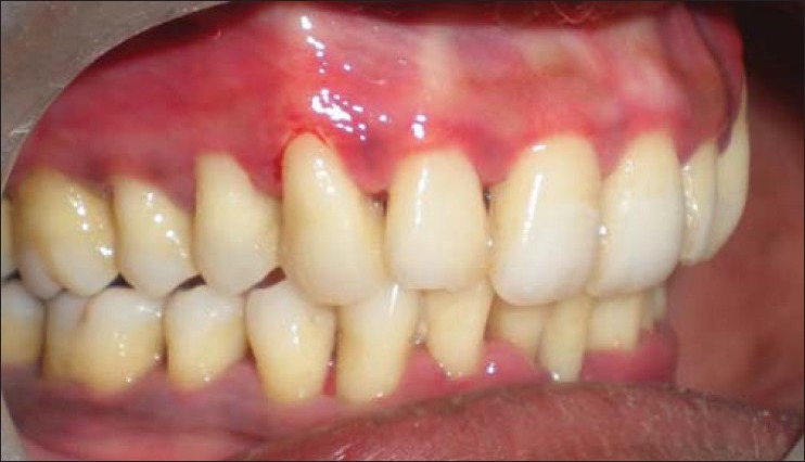 Scurvy-scorbutic siderosis of gingiva: A diagnostic challenge - A rare ...