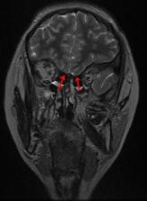 Le Syndrome De Kallmann-de Morsier: à Propos De Trois Cas – Scienceopen