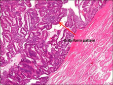 Solitary Testicular Metastasis of Prostate Cancer Mimicking Primary ...