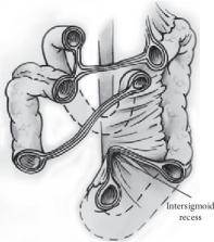 Intersigmoid Hernia: A Forgotten Diagnosis—a Systematic Review Of The 