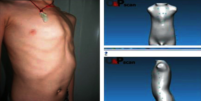 How the Dynamic Chest Compressor works for Pectus Carinatum