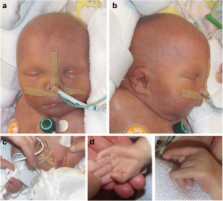 De novo duplication of chromosome 16p in a female infant with signs of