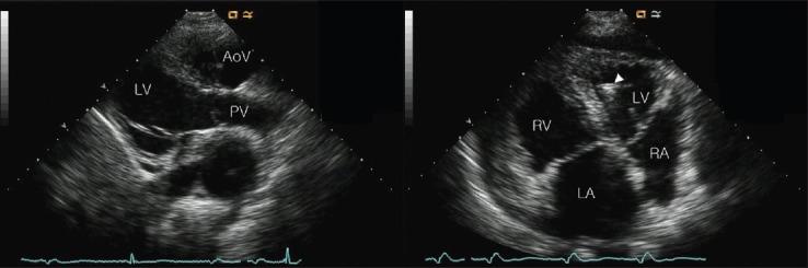 Complete atrioventricular block in an adult with congenitally corrected ...