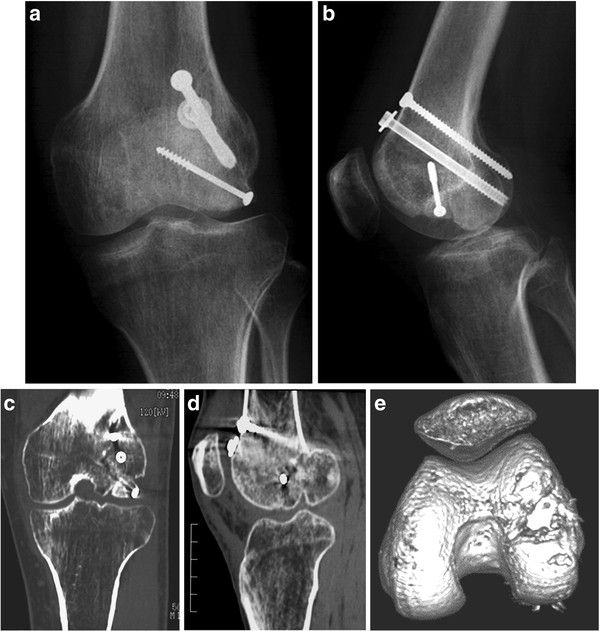 Intra-articular corrective osteotomy for malunited Hoffa ...