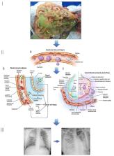 Sepsis: Evolving Concepts And Challenges – ScienceOpen