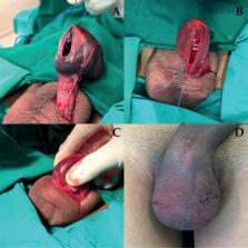 testicular torsion intravaginal