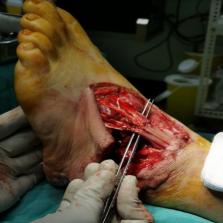 Evaluation And Management Of Crush Injuries Of The Foot
