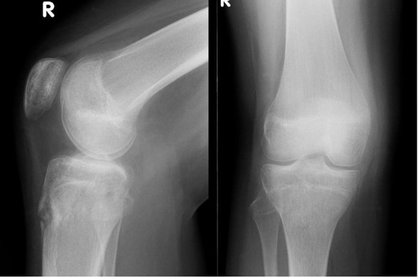 Salter-Harris II injury of the proximal tibial epiphysis with both ...