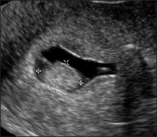 Saline infusion sonohysterography versus hysteroscopy for uterine ...