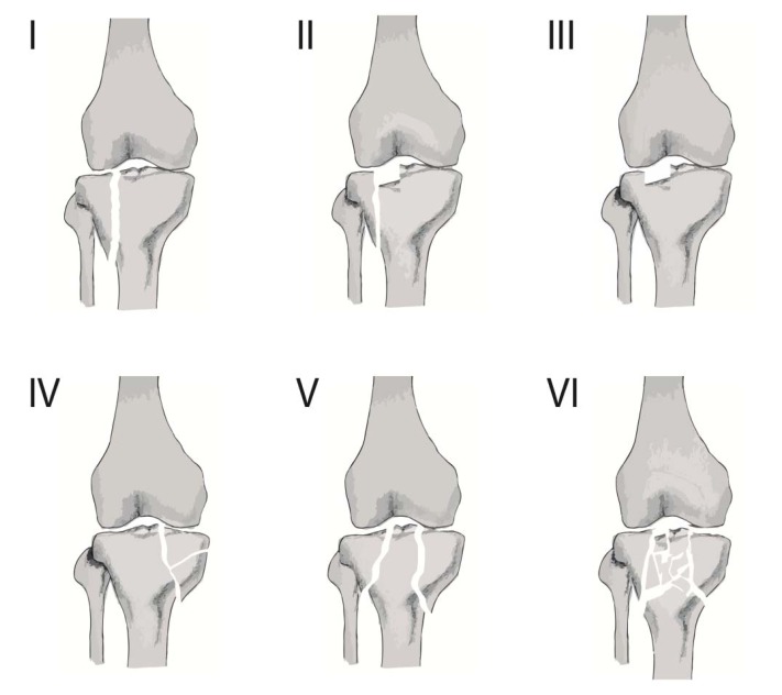 Periarticular Fractures of the Knee in Polytrauma Patients – ScienceOpen