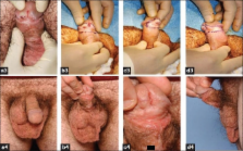 The Surgical Treatment Of Balanitis Xerotica Obliterans Scienceopen