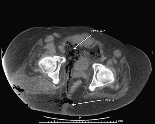 Group B Streptococcal Necrotizing Fasciitis From A Decubitus Ulcer