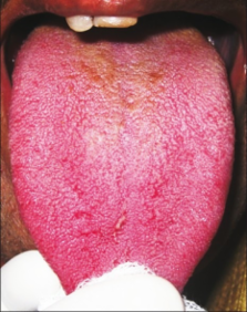 uremic stomatitis