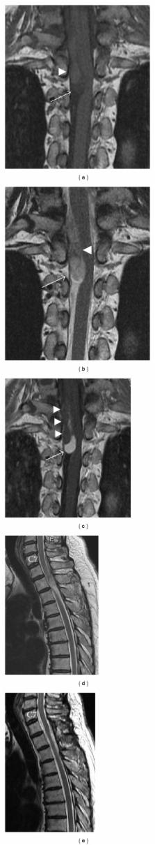 Intradural Extramedullary Capillary Hemangioma in the Upper Thoracic ...